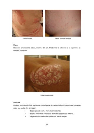 Pápula. Urticaria Pápula. Xantomas eruptivos
Placa
Elevación circunscripta, sólida, mayor a 0,5 cm. Predomina la extensión a la superficie. Ej:
erisipela o psoriasis.
Placa. Psoriasis vulgar
Vesícula
Cavidad circunscripta de la epidermis, multitabicada, de contenido líquido claro que al romperse
dejan una costra. Se forma por:
• Espongiosis o edema intercelular: eccemas.
• Edema intracelular y necrosis: dermatitis de contacto irritativa.
• Degeneración balonizante y reticular: herpes simple.
17
 