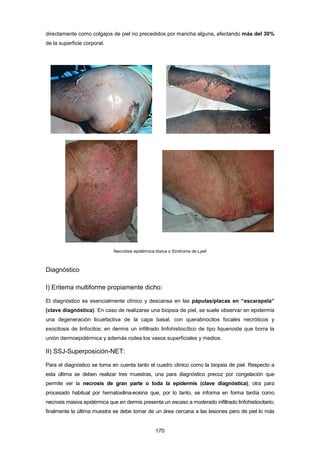 directamente como colgajos de piel no precedidos por mancha alguna, afectando más del 30%
de la superficie corporal.
Necrolisis epidérmica tóxica o Síndrome de Lyell
Diagnóstico
I) Eritema multiforme propiamente dicho:
El diagnóstico es esencialmente clínico y descansa en las pápulas/placas en “escarapela”
(clave diagnóstica). En caso de realizarse una biopsia de piel, se suele observar en epidermis
una degeneración licuefactiva de la capa basal, con queratinocitos focales necróticos y
exocitosis de linfocitos; en dermis un infiltrado linfohistiocítico de tipo liquenoide que borra la
unión dermoepidérmica y además rodea los vasos superficiales y medios.
II) SSJ-Superposición-NET:
Para el diagnóstico se toma en cuenta tanto el cuadro clínico como la biopsia de piel. Respecto a
esta última se deben realizar tres muestras, una para diagnóstico precoz por congelación que
permite ver la necrosis de gran parte o toda la epidermis (clave diagnóstica); otra para
procesado habitual por hematoxilina-eosina que, por lo tanto, se informa en forma tardía como
necrosis masiva epidérmica que en dermis presenta un escaso a moderado infiltrado linfohistiocitario;
finalmente la última muestra se debe tomar de un área cercana a las lesiones pero de piel lo más
170
 