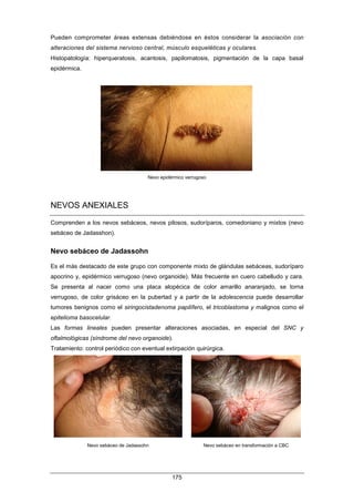 Pueden comprometer áreas extensas debiéndose en éstos considerar la asociación con
alteraciones del sistema nervioso central, músculo esqueléticas y oculares.
Histopatología: hiperqueratosis, acantosis, papilomatosis, pigmentación de la capa basal
epidérmica.
Nevo epidérmico verrugoso
NEVOS ANEXIALES
Comprenden a los nevos sebáceos, nevos pilosos, sudoríparos, comedoniano y mixtos (nevo
sebáceo de Jadasshon).
Nevo sebáceo de Jadassohn
Es el más destacado de este grupo con componente mixto de glándulas sebáceas, sudoríparo
apocrino y, epidérmico verrugoso (nevo organoide). Más frecuente en cuero cabelludo y cara.
Se presenta al nacer como una placa alopécica de color amarillo anaranjado, se torna
verrugoso, de color grisáceo en la pubertad y a partir de la adolescencia puede desarrollar
tumores benignos como el siringocistadenoma papilífero, el tricoblastoma y malignos como el
epitelioma basocelular.
Las formas lineales pueden presentar alteraciones asociadas, en especial del SNC y
oftalmológicas (síndrome del nevo organoide).
Tratamiento: control periódico con eventual extirpación quirúrgica.
Nevo sebáceo de Jadassohn Nevo sebáceo en transformación a CBC
175
 