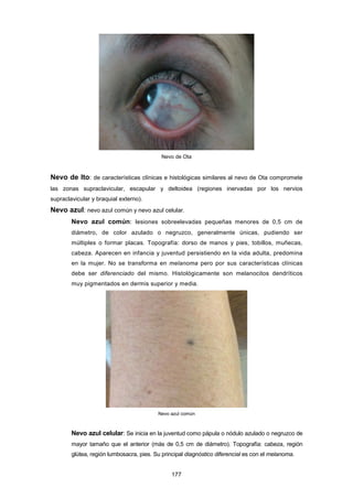 Nevo de Ota
Nevo de Ito: de características clínicas e histológicas similares al nevo de Ota compromete
las zonas supraclavicular, escapular y deltoidea (regiones inervadas por los nervios
supraclavicular y braquial externo).
Nevo azul: nevo azul común y nevo azul celular.
Nevo azul común: lesiones sobreelevadas pequeñas menores de 0,5 cm de
diámetro, de color azulado o negruzco, generalmente únicas, pudiendo ser
múltiples o formar placas. Topografía: dorso de manos y pies, tobillos, muñecas,
cabeza. Aparecen en infancia y juventud persistiendo en la vida adulta, predomina
en la mujer. No se transforma en melanoma pero por sus características clínicas
debe ser diferenciado del mismo. Histológicamente son melanocitos dendríticos
muy pigmentados en dermis superior y media.
Nevo azul común
Nevo azul celular: Se inicia en la juventud como pápula o nódulo azulado o negruzco de
mayor tamaño que el anterior (más de 0,5 cm de diámetro). Topografía: cabeza, región
glútea, región lumbosacra, pies. Su principal diagnóstico diferencial es con el melanoma.
177
 