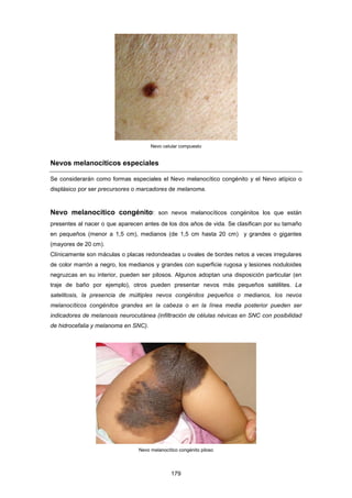 Nevo celular compuesto
Nevos melanocíticos especiales
Se considerarán como formas especiales el Nevo melanocítico congénito y el Nevo atípico o
displásico por ser precursores o marcadores de melanoma.
Nevo melanocítico congénito: son nevos melanocíticos congénitos los que están
presentes al nacer o que aparecen antes de los dos años de vida. Se clasifican por su tamaño
en pequeños (menor a 1,5 cm), medianos (de 1,5 cm hasta 20 cm) y grandes o gigantes
(mayores de 20 cm).
Clínicamente son máculas o placas redondeadas u ovales de bordes netos a veces irregulares
de color marrón a negro, los medianos y grandes con superficie rugosa y lesiones noduloides
negruzcas en su interior, pueden ser pilosos. Algunos adoptan una disposición particular (en
traje de baño por ejemplo), otros pueden presentar nevos más pequeños satélites. La
satelitosis, la presencia de múltiples nevos congénitos pequeños o medianos, los nevos
melanocíticos congénitos grandes en la cabeza o en la línea media posterior pueden ser
indicadores de melanosis neurocutánea (infiltración de células névicas en SNC con posibilidad
de hidrocefalia y melanoma en SNC).
Nevo melanocítico congénito piloso
179
 