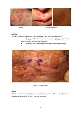 Vesícula Vesícula. Herpes simple
Ampolla
Cavidad de contenido líquido claro, de un tamaño > 0,5 cm, unilocular, se forma por:
• Despegamiento epidérmico: subcórneo en el impétigo y subepidérmico
en la Dermatitis Herpetiforme y Penfigoides
• Acantólisis: por ruptura de los desmosomas como en los pénfigos.
Ampolla. Penfigoide ampollar
Pústula
Elevación circunscripta de la piel, cuyo contenido es purulento desde su inicio. Pueden ser
foliculares o no foliculares. Ej acné y psoriasis pustulosa.
18
 