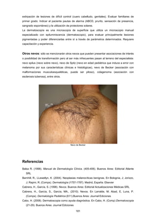 extirpación de lesiones de difícil control (cuero cabelludo, genitales). Evaluar familiares de
primer grado. Indicar al paciente pautas de alarma (ABCD, prurito, sensación de presencia,
sangrado espontáneo) y la utilización de protectores solares.
La dermatoscopía es una microscopía de superficie que utiliza un microscopio manual
especializado con epiluminiscencia (dermatoscopio), para evaluar principalmente lesiones
pigmentadas y poder diferenciarlas entre sí a través de parámetros determinados. Requiere
capacitación y experiencia.
Otros nevos: sólo se mencionarán otros nevos que pueden presentar asociaciones de interés
o posibilidad de transformación pero al ser más infrecuentes pasan al terreno del especialista:
nevo spilus (nevo sobre nevo), nevo de Spitz (nevo en edad pediátrica que induce a error con
melanoma por sus características clínicas e histológicas), nevo de Becker (asociación con
malformaciones musculoesqueléticas, puede ser piloso), colagenoma (asociación con
esclerosis tuberosa), entre otros.
Nevo de Becker
Referencias
Balsa R. (1998). Manual de Dermatología Clínica. (405-406). Buenos Aires: Editorial Atlante
SRL
Barnhill, R., LLewellyn, K. (2004). Neoplasias melanocíticas benignas. En Bolognia, J; Jorizzo,
J; Rapini, R. (Comps). Dermatología (1757-1787). Madrid, España: Elsevier
Cabrera, H., García, S. (1998). Nevos. Buenos Aires: Editorial Actualizaciones Médicas SRL
Cabrera, H., García, S., García, MA., (2010). Nevos. En Larralde, M; Abad, E, Luna, P.
(Comps). Dermatología Pediátrica (611).Buenos Aires: Journal Ediciones
Cabo, H. (2008). Dermatoscopia como ayuda diagnóstica. En Cabo, H. (Comp) Dermatoscopia
(21-29). Buenos Aires: Journal Ediciones
181
 