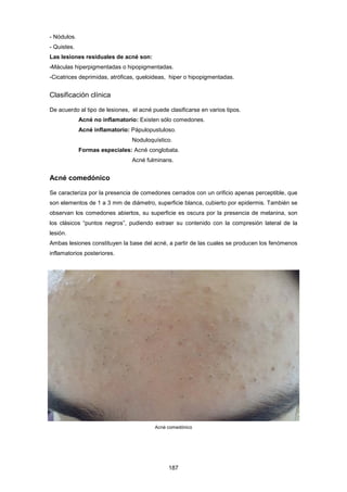 - Nódulos.
- Quistes.
Las lesiones residuales de acné son:
-Máculas hiperpigmentadas o hipopigmentadas.
-Cicatrices deprimidas, atróficas, queloideas, hiper o hipopigmentadas.
Clasificación clínica
De acuerdo al tipo de lesiones, el acné puede clasificarse en varios tipos.
Acné no inflamatorio: Existen sólo comedones.
Acné inflamatorio: Pápulopustuloso.
Noduloquístico.
Formas especiales: Acné conglobata.
Acné fulminans.
Acné comedónico
Se caracteriza por la presencia de comedones cerrados con un orificio apenas perceptible, que
son elementos de 1 a 3 mm de diámetro, superficie blanca, cubierto por epidermis. También se
observan los comedones abiertos, su superficie es oscura por la presencia de melanina, son
los clásicos “puntos negros”, pudiendo extraer su contenido con la compresión lateral de la
lesión.
Ambas lesiones constituyen la base del acné, a partir de las cuales se producen los fenómenos
inflamatorios posteriores.
Acné comedónico
187
 