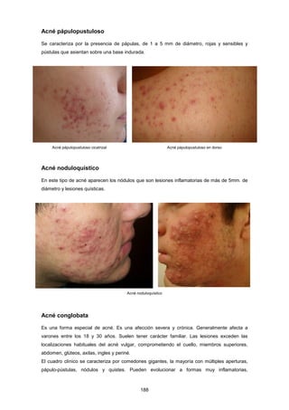 Acné pápulopustuloso
Se caracteriza por la presencia de pápulas, de 1 a 5 mm de diámetro, rojas y sensibles y
pústulas que asientan sobre una base indurada.
Acné pápulopustuloso cicatrizal Acné pápulopustuloso en dorso
Acné noduloquístico
En este tipo de acné aparecen los nódulos que son lesiones inflamatorias de más de 5mm. de
diámetro y lesiones quísticas.
Acné noduloquístico
Acné conglobata
Es una forma especial de acné. Es una afección severa y crónica. Generalmente afecta a
varones entre los 18 y 30 años. Suelen tener carácter familiar. Las lesiones exceden las
localizaciones habituales del acné vulgar, comprometiendo el cuello, miembros superiores,
abdomen, glúteos, axilas, ingles y periné.
El cuadro clínico se caracteriza por comedones gigantes, la mayoría con múltiples aperturas,
pápulo-pústulas, nódulos y quistes. Pueden evolucionar a formas muy inflamatorias,
188
 
