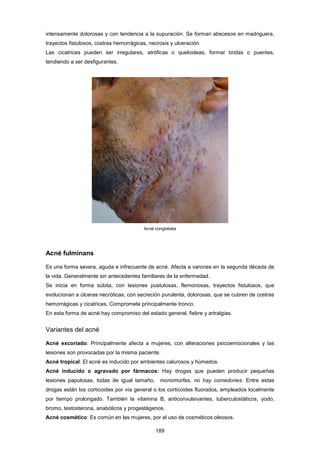 intensamente dolorosas y con tendencia a la supuración. Se forman abscesos en madriguera,
trayectos fistulosos, costras hemorrágicas, necrosis y ulceración.
Las cicatrices pueden ser irregulares, atróficas o queloideas, formar bridas o puentes,
tendiendo a ser desfigurantes.
Acné conglobata
Acné fulminans
Es una forma severa, aguda e infrecuente de acné. Afecta a varones en la segunda década de
la vida. Generalmente sin antecedentes familiares de la enfermedad.
Se inicia en forma súbita, con lesiones pustulosas, flemonosas, trayectos fistulosos, que
evolucionan a úlceras necróticas, con secreción purulenta, dolorosas, que se cubren de costras
hemorrágicas y cicatrices. Compromete principalmente tronco.
En esta forma de acné hay compromiso del estado general, fiebre y artralgias.
Variantes del acné
Acné excoriado: Principalmente afecta a mujeres, con alteraciones psicoemocionales y las
lesiones son provocadas por la misma paciente.
Acné tropical: El acné es inducido por ambientes calurosos y húmedos.
Acné inducido o agravado por fármacos: Hay drogas que pueden producir pequeñas
lesiones papulosas, todas de igual tamaño, monomorfas, no hay comedones. Entre estas
drogas están los corticoides por vía general o los corticoides fluorados, empleados localmente
por tiempo prolongado. También la vitamina B, anticonvulsivantes, tuberculostáticos, yodo,
bromo, testosterona, anabólicos y progestágenos.
Acné cosmético: Es común en las mujeres, por el uso de cosméticos oleosos.
189
 