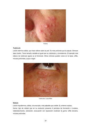 Pústula
Tubérculo
Lesión dérmica sólida, que hace relieve sobre la piel. Es más profunda que la pápula. Siempre
deja cicatriz. Tiene tamaño variable al igual que su coloración y consistencia. El ejemplo más
clásico de tubérculo agudo es el forúnculo. Otros crónicos pueden verse en la lepra, sífilis,
micosis profundas y lupus vulgar.
Tubérculos. Lupus Miliar
Nódulo
Lesión hipodérmica, sólida, circunscripta, más palpable que visible. Ej: eritema nudoso.
Goma: tipo de nódulo que en su evolución presenta 4 períodos de formación o crudeza,
reblandecimiento, ulceración, evacuación con reparación cicatrizal. Ej goma: sífilis terciaria,
micosis profundas.
19
 
