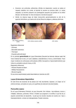 • Escamas: son profundas, adherentes, difíciles de desprender; cuando se realiza el
raspado metódico con cureta, al levantar la escama se provoca dolor y a veces
sangrado. La escama presenta una prolongación pequeña que penetra en el orificio
folicular. Son llamadas “en clavo de tapicero o bonete de payaso”.
• Atrofia: se observa luego de haber transcurrido aproximadamente un año de la
aparición del eritema, por destrucción de las fibras de colágeno y elásticas dérmicas.
LDC: eritema, escama y
atrofia
LDC: eritema, escama y atrofia LDC: atrofia
Diagnóstico diferencial:
- Psoriasis
- Dermatitis seborreica
- Tiña facial
- Erupción polimorfa facial
En la variedad generalizada de Lupus Eritematoso Discoide las lesiones clásicas salen del
marco habitual de la cara y el cuero cabelludo, extendiéndose a tronco y extremidades. Tiene
mayor incidencia de anticuerpos antinucleares (ANA), leucopenia e hipocomplementemia que
indican su probable evolución hacia un LES.
Diagnóstico diferencial
- Pitiriasis Rosada de Gibert
- Sifilides Psoriasiforme
- Micosis fungoide
El carcinoma espinocelular puede desarrollarse en lesiones de LED.
Lupus Eritematoso Hipertrófico
En esta forma las escamas de las placas son más abundantes, espesas y no dejan ver el
eritema de base, se localiza en cara y en superficies de extensión de extremidades.
Paniculitis Lúpica
Es el Lupus Eritematoso Profundo, es poco frecuente. Son nódulos rojo-violáceos, únicos o
múltiples, dolorosos, profundos, firmes o móviles que progresan a la atrofia, lo que les da un
aspecto característico de lipoatrofia, la piel que los recubre resuelve sin cicatriz con hipo o
hiperpigmentación, a veces con telangiectasias. Pueden ulcerarse.
194
 