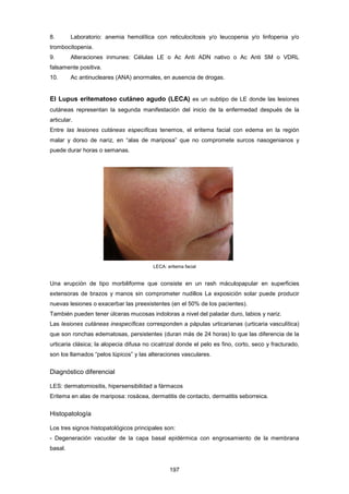 8. Laboratorio: anemia hemolítica con reticulocitosis y/o leucopenia y/o linfopenia y/o
trombocitopenia.
9. Alteraciones inmunes: Células LE o Ac Anti ADN nativo o Ac Anti SM o VDRL
falsamente positiva.
10. Ac antinucleares (ANA) anormales, en ausencia de drogas.
El Lupus eritematoso cutáneo agudo (LECA) es un subtipo de LE donde las lesiones
cutáneas representan la segunda manifestación del inicio de la enfermedad después de la
articular.
Entre las lesiones cutáneas específicas tenemos, el eritema facial con edema en la región
malar y dorso de nariz, en “alas de mariposa” que no compromete surcos nasogenianos y
puede durar horas o semanas.
Una erupción de tipo morbiliforme que consiste en un rash máculopapular en superficies
extensoras de brazos y manos sin comprometer nudillos La exposición solar puede producir
nuevas lesiones o exacerbar las preexistentes (en el 50% de los pacientes).
También pueden tener úlceras mucosas indoloras a nivel del paladar duro, labios y nariz.
Las lesiones cutáneas inespecíficas corresponden a pápulas urticarianas (urticaria vasculítica)
que son ronchas edematosas, persistentes (duran más de 24 horas) lo que las diferencia de la
urticaria clásica; la alopecia difusa no cicatrizal donde el pelo es fino, corto, seco y fracturado,
son los llamados “pelos lúpicos” y las alteraciones vasculares.
Diagnóstico diferencial
LES: dermatomiositis, hipersensibilidad a fármacos
Eritema en alas de mariposa: rosácea, dermatitis de contacto, dermatitis seborreica.
Histopatología
Los tres signos histopatológicos principales son:
- Degeneración vacuolar de la capa basal epidérmica con engrosamiento de la membrana
basal.
LECA: eritema facial
197
 