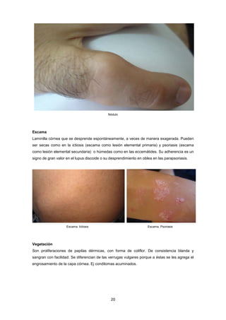 Nódulo
Escama
Laminilla córnea que se desprende espontáneamente, a veces de manera exagerada. Pueden
ser secas como en la ictiosis (escama como lesión elemental primaria) y psoriasis (escama
como lesión elemental secundaria) o húmedas como en las eccemátides. Su adherencia es un
signo de gran valor en el lupus discoide o su desprendimiento en oblea en las parapsoriasis.
Escama. Ictiosis Escama. Psoriasis
Vegetación
Son proliferaciones de papilas dérmicas, con forma de coliflor. De consistencia blanda y
sangran con facilidad. Se diferencian de las verrugas vulgares porque a éstas se les agrega el
engrosamiento de la capa córnea. Ej condilomas acuminados.
20
 
