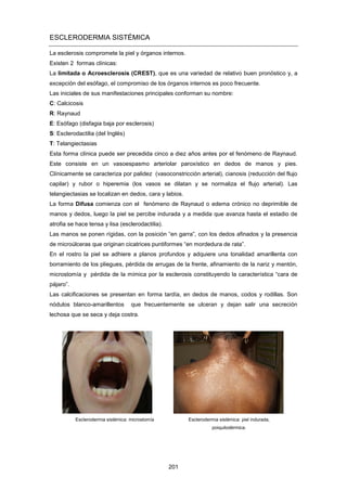 ESCLERODERMIA SISTÉMICA
La esclerosis compromete la piel y órganos internos.
Existen 2 formas clínicas:
La limitada o Acroesclerosis (CREST), que es una variedad de relativo buen pronóstico y, a
excepción del esófago, el compromiso de los órganos internos es poco frecuente.
Las iniciales de sus manifestaciones principales conforman su nombre:
C: Calcicosis
R: Raynaud
E: Esófago (disfagia baja por esclerosis)
S: Esclerodactilia (del Inglés)
T: Telangiectasias
Esta forma clínica puede ser precedida cinco a diez años antes por el fenómeno de Raynaud.
Este consiste en un vasoespasmo arteriolar paroxístico en dedos de manos y pies.
Clínicamente se caracteriza por palidez (vasoconstricción arterial), cianosis (reducción del flujo
capilar) y rubor o hiperemia (los vasos se dilatan y se normaliza el flujo arterial). Las
telangiectasias se localizan en dedos, cara y labios.
La forma Difusa comienza con el fenómeno de Raynaud o edema crónico no deprimible de
manos y dedos, luego la piel se percibe indurada y a medida que avanza hasta el estadio de
atrofia se hace tensa y lisa (esclerodactilia).
Las manos se ponen rígidas, con la posición “en garra”, con los dedos afinados y la presencia
de microúlceras que originan cicatrices puntiformes “en mordedura de rata”.
En el rostro la piel se adhiere a planos profundos y adquiere una tonalidad amarillenta con
borramiento de los pliegues, pérdida de arrugas de la frente, afinamiento de la nariz y mentón,
microstomía y pérdida de la mímica por la esclerosis constituyendo la característica “cara de
pájaro”.
Las calcificaciones se presentan en forma tardía, en dedos de manos, codos y rodillas. Son
nódulos blanco-amarillentos que frecuentemente se ulceran y dejan salir una secreción
lechosa que se seca y deja costra.
Esclerodermia sistémica: microstomía Esclerodermia sistémica: piel indurada,
poiquilodérmica.
201
 
