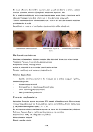 En zonas extensoras de miembros superiores, cara y cuello se observa un eritema violáceo
macular, confluente, simétrico y pruriginoso, denominado “signo del Chall”.
En el estado poiquilodérmico se conjugan telangiectasias, atrofia, hiper e hipocromía; se lo
observa en la etapa crónica de la enfermedad en dorso de manos, cara y cuello.
También presentan marcada fotosensibilidad, que a nivel de la V del cuello aumenta el aspecto
poiquilodérmico de la piel.
La calcicosis es frecuente en los niños (en músculos o tejido celular subcutáneo).
Dermatomiositis: edema de párpados Dermatomiositis: pápulas de
Gottron
Dermatomiositis: poiquilodermia
Manifestaciones sistémicas
Digestivas: disfagia alta por debilidad muscular, dolor abdominal, ulceraciones y hemorragias.
Vasculares: Raynaud, livedo reticular, úlceras cutáneas.
Respiratorias: disnea, fibrosis pulmonar.
Cardíacas: trastornos de la conducción o insuficiencia cardíaca.
Renales: insuficiencia renal aguda por mioglobulinemia.
Criterios diagnósticos
- Debilidad simétrica proximal de los músculos, de la cintura escapular y pélvica,
extremidades y cuello.
- Biopsia muscular anormal.
- Enzimas séricas de músculo esquelético elevadas.
- Tríada electromiográfica característica.
- Hallazgos dermatológicos típicos.
Exámenes complementarios
Laboratorio: Presentan anemia, leucocitosis, ERS elevada e hipoalbuminemia. El compromiso
muscular se puede evaluar por la elevación de enzimas como Aldolasa, Creatin fosfoquinasa
(CPK), láctico-deshidrogenasa (LDH); GOT y GPT.
En el compromiso sistémico se observa la presencia del Ac Anti Jo que se asocia con Fibrosis
Pulmonar, Raynaud, Sjogren y artritis; siendo un signo de mal pronóstico.
Los anticuerpos ANA y anti ADN pueden ser positivos.
Electromiograma: miopatía.
Biopsia muscular: miositis
204
 
