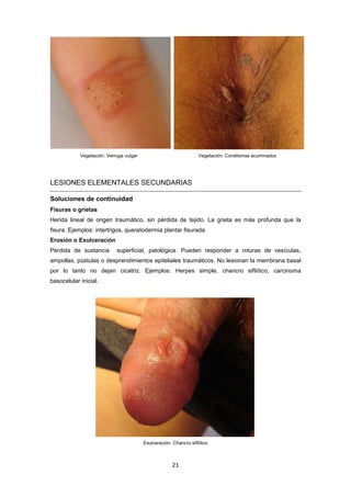 Vegetación. Verruga vulgar Vegetación. Condilomas acuminados
LESIONES ELEMENTALES SECUNDARIAS
Soluciones de continuidad
Fisuras o grietas
Herida lineal de origen traumático, sin pérdida de tejido. La grieta es más profunda que la
fisura. Ejemplos: intertrigos, queratodermia plantar fisurada.
Erosión o Exulceración
Pérdida de sustancia superficial, patológica. Pueden responder a roturas de vesículas,
ampollas, pústulas o desprendimientos epiteliales traumáticos. No lesionan la membrana basal
por lo tanto no dejan cicatriz. Ejemplos: Herpes simple, chancro sifilítico, carcinoma
basocelular inicial.
Exulceración. Chancro sifilítico
21
 