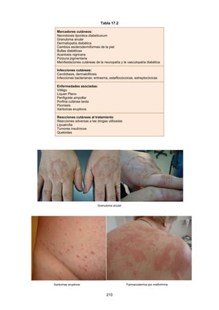 Tabla 17.2
Marcadores cutáneos:
Necrobiosis lipoídica diabeticorum
Granuloma anular
Dermatopatía diabética
Cambios esclerodermiformes de la piel
Bullas diabéticas
Acantosis nigricans
Púrpura pigmentaria
Manifestaciones cutáneas de la neuropatía y la vasculopatía diabética
Infecciones cutáneas:
Candidiasis, dermatofitosis
Infecciones bacterianas: eritrasma, estafilocóccicas, estreptocócicas
Enfermedades asociadas:
Vitiligo
Liquen Plano
Penfigoide ampollar
Porfiria cutánea tarda
Psoriasis
Xantomas eruptivos
Reacciones cutáneas al tratamiento
Reacciones adversas a las drogas utilizadas
Lipoatrofia
Tumores insulínicos
Queloides
Granuloma anular
Xantomas eruptivos Farmacodermia por metformina
210
 
