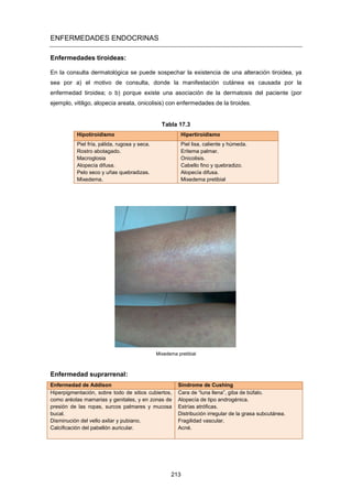 ENFERMEDADES ENDOCRINAS
Enfermedades tiroideas:
En la consulta dermatológica se puede sospechar la existencia de una alteración tiroidea, ya
sea por a) el motivo de consulta, donde la manifestación cutánea es causada por la
enfermedad tiroidea; o b) porque existe una asociación de la dermatosis del paciente (por
ejemplo, vitiligo, alopecia areata, onicolisis) con enfermedades de la tiroides.
Tabla 17.3
Hipotiroidismo Hipertiroidismo
Piel fría, pálida, rugosa y seca.
Rostro abotagado.
Macroglosia
Alopecía difusa.
Pelo seco y uñas quebradizas.
Mixedema.
Piel lisa, caliente y húmeda.
Eritema palmar.
Onicolisis.
Cabello fino y quebradizo.
Alopecía difusa.
Mixedema pretibial
Mixedema pretibial
Enfermedad suprarrenal:
Enfermedad de Addison Síndrome de Cushing
Hiperpigmentación, sobre todo de sitios cubiertos,
como aréolas mamarias y genitales, y en zonas de
presión de las ropas, surcos palmares y mucosa
bucal.
Disminución del vello axilar y pubiano.
Calcificación del pabellón auricular.
Cara de “luna llena”, giba de búfalo.
Alopecía de tipo androgénica.
Estrías atróficas.
Distribución irregular de la grasa subcutánea.
Fragilidad vascular.
Acné.
213
 