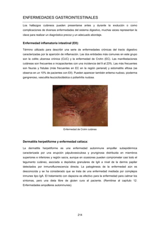 ENFERMEDADES GASTROINTESTINALES
Los hallazgos cutáneos pueden presentarse antes y durante la evolución o como
complicaciones de diversas enfermedades del sistema digestivo, muchas veces representan la
clave para realizar un diagnóstico precoz y un adecuado abordaje.
Enfermedad inflamatoria intestinal (EII):
Término utilizado para describir una serie de enfermedades crónicas del tracto digestivo
caracterizadas por la aparición de inflamación. Las dos entidades más comunes en este grupo
son la colitis ulcerosa crónica (CUC) y la enfermedad de Crohn (EC). Las manifestaciones
cutáneas son frecuentes e incapacitantes con una incidencia del 9 al 23%. Las más frecuentes
son fisuras y fístulas (más frecuentes en EC en la región perianal) y estomatitis aftosa (se
observa en un 10% de pacientes con EII). Pueden aparecer también eritema nudoso, pioderma
gangrenoso, vasculitis leucocitoclástica o poliartritis nudosa.
Enfermedad de Crohn cutánea
Dermatitis herpetiforme y enfermedad celíaca:
La dermatitis herpetiforme es una enfermedad autoinmune ampollar subepidérmica
caracterizada por una erupción pápulovesiculosa y pruriginosa distribuida en miembros
superiores e inferiores y región sacra, aunque en ocasiones pueden comprometer casi todo el
tegumento cutáneo, asociada a depósitos granulares de IgA a nivel de la dermis papilar
detectados por inmunofluorescencia directa. La patogénesis de la enfermedad aún es
desconocida y se ha considerado que se trata de una enfermedad mediada por complejos
inmunes tipo IgA. El tratamiento con dapsona es efectivo para la enfermedad para calmar los
síntomas, pero una dieta libre de gluten cura al paciente. (Remitirse al capítulo 12:
Enfermedades ampollares autoinmunes).
214
 