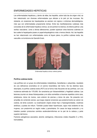 ENFERMEDADES HEPÁTICAS
Las enfermedades hepáticas y, dentro de ellas, las hepatitis, sobre todo las de origen viral, se
han relacionado con diversas enfermedades que afectan a la piel y/o las mucosas. No
obstante, en ocasiones las hepatopatías se asocian con signos o síntomas dermatológicos,
más que con enfermedades propiamente dichas. Entre las manifestaciones cutáneas más
conocidas de la enfermedad hepática crónica, se encuentran la ictericia, el eritema palmar y las
arañas vasculares. Junto a dichas alteraciones, pueden aparecer otras lesiones cutáneas en
las cuales la hepatopatía posee un papel etiopatogénico más o menos directo. Así, las hepatitis
se han relacionado con enfermedades como el liquen plano, la porfiria cutánea tarda, las
vasculitis o el síndrome de Gianotti-Crosti.
Enfermedad hepática crónica: eritema palmar
Porfiria cutánea tarda
Las porfirias son un grupo de enfermedades metabólicas, hereditarias o adquiridas, resultado
de una deficiencia enzimática en el camino biosintético del hemo. De los distintos tipos
descriptos, la porfiria cutánea tarda (PCT) es la forma más frecuente de las porfirias, con una
incidencia estimada de 1/70.000. Se caracteriza por fotosensibilidad y fragilidad cutánea. Las
lesiones ocurren en áreas fotoexpuestas y en sitios sometidos a traumas repetidos como cara,
antebrazos, dorso de manos, cara anterior de piernas y dorso de pies. Se presenta con
ampollas de contenido seroso, que luego originan erosiones que posteriormente se cubren de
costras, de lenta curación. La cicatrización origina áreas hipo o hiperpigmentadas, cicatrices
atróficas y quistes de milium. También puede haber hipertricosis, signo más evidente en las
mujeres, con predominio en región malar y periorbitaria. En casos de larga evolución y no
tratados pueden producirse cambios esclerodermiformes en la piel de la cabeza y parte
superior del tronco.
Factores patogénicos asociados: alcohol, estrógenos, infecciones virales (hepatitis C y HIV),
hemodiálisis.
215
 