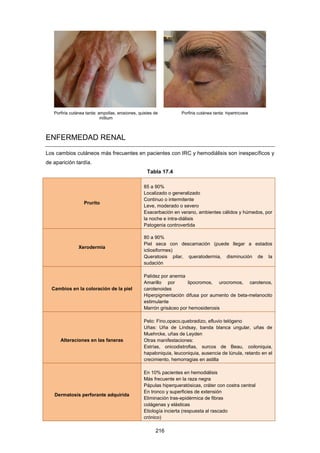 Porfiria cutánea tarda: ampollas, erosiones, quistes de
millium
Porfiria cutánea tarda: hipertricosis
ENFERMEDAD RENAL
Los cambios cutáneos más frecuentes en pacientes con IRC y hemodiálisis son inespecíficos y
de aparición tardía.
Tabla 17.4
Prurito
85 a 90%
Localizado o generalizado
Continuo o intermitente
Leve, moderado o severo
Exacerbación en verano, ambientes cálidos y húmedos, por
la noche e intra-diálisis
Patogenia controvertida
Xerodermia
80 a 90%
Piel seca con descamación (puede llegar a estados
ictiosiformes)
Queratosis pilar, queratodermia, disminución de la
sudación
Cambios en la coloración de la piel
Palidez por anemia
Amarillo por lipocromos, urocromos, carotenos,
carotenoides
Hiperpigmentación difusa por aumento de beta-melanocito
estimulante
Marrón grisáceo por hemosiderosis
Alteraciones en las faneras
Pelo: Fino,opaco,quebradizo, efluvio telógeno
Uñas: Uña de Lindsay, banda blanca ungular, uñas de
Muehrcke, uñas de Leyden
Otras manifestaciones:
Estrías, onicodistrofias, surcos de Beau, coiloniquia,
hapaloniquia, leuconiquia, ausencia de lúnula, retardo en el
crecimiento, hemorragias en astilla
Dermatosis perforante adquirida
En 10% pacientes en hemodiálisis
Más frecuente en la raza negra
Pápulas hiperqueratósicas, cráter con costra central
En tronco y superficies de extensión
Eliminación tras-epidérmica de fibras
colágenas y elásticas
Etiología incierta (respuesta al rascado
crónico)
216
 