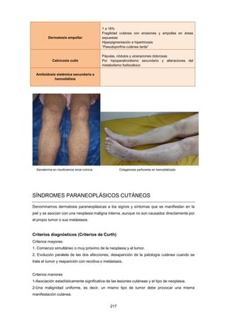 Dermatosis ampollar
1 a 16%
Fragilidad cutánea con erosiones y ampollas en áreas
expuestas
Hiperpigmentación e hipertricosis
“Pseudoporfiria cutánea tarda”
Calcicosis cutis
Pápulas, nódulos y ulceraciones dolorosas
Por hipoparatiroidismo secundario y alteraciones del
metabolismo fosfocálcico
Amiloidosis sistémica secundaria a
hemodiálisis
Xerodermia en insuficiencia renal crónica Colagenosis perforante en hemodializado
SÍNDROMES PARANEOPLÁSICOS CUTÁNEOS
Denominamos dermatosis paraneoplásicas a los signos y síntomas que se manifiestan en la
piel y se asocian con una neoplasia maligna interna, aunque no son causados directamente por
el propio tumor o sus metástasis.
Criterios diagnósticos (Criterios de Curth)
Criterios mayores:
1. Comienzo simultáneo o muy próximo de la neoplasia y el tumor.
2. Evolución paralela de las dos afecciones, desaparición de la patología cutánea cuando se
trata el tumor y reaparición con recidiva o metástasis.
Criterios menores
1-Asociación estadísticamente significativa de las lesiones cutáneas y el tipo de neoplasia.
2-Una malignidad uniforme, es decir, un mismo tipo de tumor debe provocar una misma
manifestación cutánea.
217
 