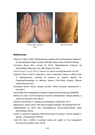 Dermatomiositis: pápulas de
Gottron
Signo de LeserTrelat
Referencias:
Cabrera H, Gatti C (2003). Manifestaciones cutáneas de las enfermedades sistémicas.
En Dermatología de Gatti- Cardama (456-466). Buenos Aires: Editorial El Ateneo.
Fernandez Bussy R(h), Larraza M (2013). Manifestaciones Cutáneas de
Enfermedades Sistemicas. Rev. Méd. Rosario 79: 78-89
Gómez Hoyos E, Levy E (2012). Diabetic foot. Semin Fund Esp Reumatol.119–129
Graham A, Robin A (2014). Goldsmith L., Katz S, Gilchrest B, Paller A, Leffell D, Wolf
K. Manifestaciones cutáneas de trastorno de órganos internos. En
FitzpatrickDermatología en Medicina General (1919-1838). España: Editorial
médica Panamericana.
GravinaAG (2016). Crohn's disease and skin. United European Gastroenterol J.
4(2):165-71.
Lee A (2009). Skin manifestations of systemic disease.Austral Family Phys 30:498-505.
Markova A, Lester J (2012) Diagnosis of common dermopathies in dialysis patients: a
review and upd.Semin Dial.:408-18.
Ramos E, Silva M (2011). Cutaneous paraneoplasia. ClinDermatol. 541-7
Rigopoulos R, Larios G (2011). Skin signs of systemic diseases. Clin Dermatol 29:531-40.
Robles-Mendez JC (2015) Skin manifestations of chronic kidney disease. Actas
Dermosifiliogr. 609-22.
Suzuki K, Tamano M, Katayama (2014).World Study of pruritus in chronic hepatitis C
patients. J Gastroenterol 17877-82
Tuerk MJ, Koo J (2008). A practical review and update on the management
of pruritus sine materia. Cutis: 187-94
219
 