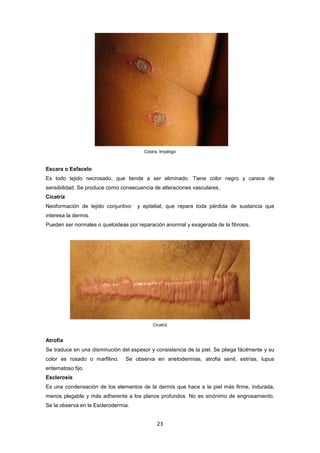 Costra. Impétigo
Escara o Esfacelo
Es todo tejido necrosado, que tiende a ser eliminado. Tiene color negro y carece de
sensibilidad. Se produce como consecuencia de alteraciones vasculares.
Cicatriz
Neoformación de tejido conjuntivo y epitelial, que repara toda pérdida de sustancia que
interesa la dermis.
Pueden ser normales o queloideas por reparación anormal y exagerada de la fibrosis.
Cicatriz
Atrofia
Se traduce en una disminución del espesor y consistencia de la piel. Se pliega fácilmente y su
color es rosado o marfilino. Se observa en anetodermias, atrofia senil, estrías, lupus
eritematoso fijo.
Esclerosis
Es una condensación de los elementos de la dermis que hace a la piel más firme, indurada,
menos plegable y más adherente a los planos profundos. No es sinónimo de engrosamiento.
Se la observa en la Esclerodermia.
23
 