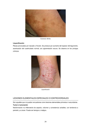 Esclerosis. Morfea
Liquenificación
Placas provocadas por rascado o fricción. Se produce por aumento del espesor del tegumento,
acentuación del cuadriculado normal, con pigmentación oscura. Se observa en los prúrigos
crónicos.
Liquenificación
LESIONES ELEMENTALES ESPECIALES O CONTROVERSIALES
Son aquellas que no pueden encuadrarse como lesiones elementales primarias ni secundarias.
Tumor o tumoración
Neoformación no inflamatoria de aspecto, volumen y consistencia variables, con tendencia a
persistir y a crecer. Puede ser benigno o maligno.
24
 