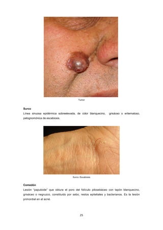 Tumor
Surco
Línea sinuosa epidérmica sobreelevada, de color blanquecino, grisáceo o eritematoso,
patognomónica de escabiosis.
Surco. Escabiosis
Comedón
Lesión “papuloide” que obtura el poro del folículo pilosebáceo con tapón blanquecino,
grisáceo o negruzco, constituido por sebo, restos epiteliales y bacterianos. Es la lesión
primordial en el acné.
25
 