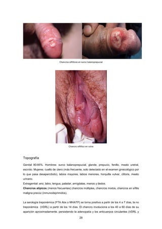 Chancro sifilítico en vulva
Topografía
Genital 80-85%. Hombres: surco balanoprepucial, glande, prepucio, fenillo, meato uretral,
escroto. Mujeres: cuello de útero (más frecuente, solo detectado en el examen ginecológico por
lo que pasa desapercibido), labios mayores, labios menores, horquilla vulvar, clítoris, meato
urinario.
Extragenital: ano, labio, lengua, paladar, amígdalas, manos y dedos.
Chancros atípicos (menos frecuentes) chancros múltiples, chancros mixtos, chancros en sífilis
maligna precoz (inmunodeprimidos).
La serología treponémica (FTA Abs o MHATP) se torna positiva a partir de los 4 a 7 días, la no
treponémica (VDRL) a partir de los 14 días. El chancro involuciona a los 40 a 60 días de su
aparición aproximadamente, persistiendo la adenopatía y los anticuerpos circulantes (VDRL y
Chancros sifilíticos en surco balanoprepucial
29
 