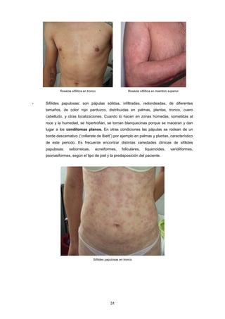 Roséola sifilítica en tronco Roséola sifilítica en miembro superior
- Sifilides papulosas: son pápulas sólidas, infiltradas, redondeadas, de diferentes
tamaños, de color rojo parduzco, distribuidas en palmas, plantas, tronco, cuero
cabelludo, y otras localizaciones. Cuando lo hacen en zonas húmedas, sometidas al
roce y la humedad, se hipertrofian, se tornan blanquecinas porque se maceran y dan
lugar a los condilomas planos. En otras condiciones las pápulas se rodean de un
borde descamativo (“collarete de Biett”) por ejemplo en palmas y plantas, característico
de este periodo. Es frecuente encontrar distintas variedades clínicas de sifilides
papulosas: seborreicas, acneiformes, foliculares, liquenoides, varioliformes,
psoriasiformes, según el tipo de piel y la predisposición del paciente.
Sifilides papulosas en tronco
31
 