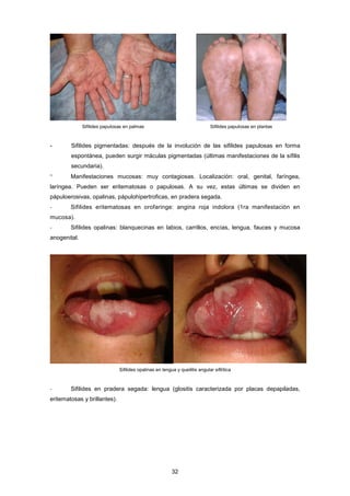 Sifilides papulosas en palmas Sifilides papulosas en plantas
- Sifilides pigmentadas: después de la involución de las sifilides papulosas en forma
espontánea, pueden surgir máculas pigmentadas (últimas manifestaciones de la sífilis
secundaria).
° Manifestaciones mucosas: muy contagiosas. Localización: oral, genital, faríngea,
laríngea. Pueden ser eritematosas o papulosas. A su vez, estas últimas se dividen en
pápuloerosivas, opalinas, pápulohipertroficas, en pradera segada.
- Sifilides eritematosas en orofaringe: angina roja indolora (1ra manifestación en
mucosa).
- Sifilides opalinas: blanquecinas en labios, carrillos, encías, lengua, fauces y mucosa
anogenital.
Sifilides opalinas en lengua y queilitis angular sifilítica
- Sifilides en pradera segada: lengua (glositis caracterizada por placas depapiladas,
eritematosas y brillantes).
32
 