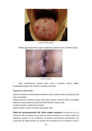 Lengua en pradera segada
- Sifilides pápulo-hipertróficas, pápulo-vegetantes o pápulo-erosivas: condilomas planos.
Condilomas planos
° Otras manifestaciones: alopecia difusa, onixis o perionixis, astenia, cefalea,
hepatoesplenomegalia, fiebre, dolores musculares, entre otros.
Diagnósticos diferenciales
Roséola: Exantemas medicamentosos, exantemas virales, roséola cerúlea de la pediculosis del
pubis, eccemátides.
Sifilides papulosas: psoriasis en gotas, liquen plano, pitiriasis rosada de Gibert, eccemátides
seborreica, eritema polimorfo, erupciones medicamentosas, rosácea, acné.
Condilomas planos: condilomas acuminados.
Sifilides opalinas: muguet, leucoplasia, liquen plano, aftas.
Sífilis del inmunosuprimido/ HIV. Sífilis maligna temprana: Se denomina así a la
variante de sífilis secundaria que se instala de manera simultánea con un chancro atípico y/o
fagedénico, seguido de una proliferación de lesiones úlcerocostrosas generalizadas, con
compromiso del estado general. Las lesiones del secundarismo son de aparición brusca y
33
 