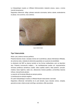 La histopatología muestra un infiltrado linfomonocitario rodeando anexos, vasos y nervios
(neuritis hanseneana).
Diagnóstico diferencial: vitíligo, pitiriasis versicolor acromiante, dartros volante, esclerodermia
en placas, nevo acrómico, nevo anémico.
Lepra indeterminada
Tipo Tuberculoide
Afecta piel y sistema nervioso periférico.
Presenta lesiones únicas o escasas (menos de 5) asimétricas, placas eritematosas infiltradas,
de contornos netos, rodeadas de elementos papuloides con ausencia de sensibilidad.
La afectación del SNP se observa también en las formas multibacilares, pero se describen
aquí. Presenta mononeuritis múltiple y las manifestaciones pueden ser: engrosamientos
nerviosos periféricos asimétricos (cubital, ciático poplíteo externo, tibial posterior, auricular,
mediano, facial, trigémino, radial, etc.), alteraciones motoras (parálisis y amiotrofias); lesiones
tróficas, (mal perforante plantar).
La reacción de Fernández Mitsuda es siempre positiva.
La baciloscopía es siempre negativa.
El cuadro histopatológico muestra un infiltrado folicular tuberculoide o sarcoidal.
Diagnóstico diferencial: dermatoficia de la piel lampiña, lupus discoide crónico, erisipela,
granuloma anular, eritema anular centrífugo, sarcoidosis, sífilis secundaria.
43
 