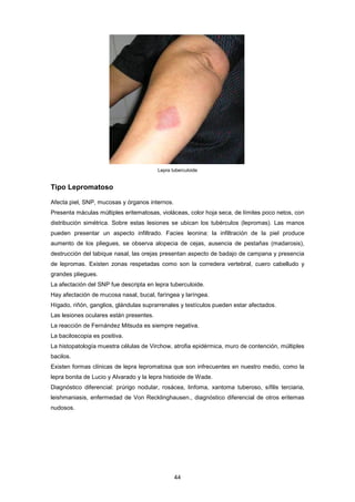 Lepra tuberculoide
Tipo Lepromatoso
Afecta piel, SNP, mucosas y órganos internos.
Presenta máculas múltiples eritematosas, violáceas, color hoja seca, de límites poco netos, con
distribución simétrica. Sobre estas lesiones se ubican los tubérculos (lepromas). Las manos
pueden presentar un aspecto infiltrado. Facies leonina: la infiltración de la piel produce
aumento de los pliegues, se observa alopecia de cejas, ausencia de pestañas (madarosis),
destrucción del tabique nasal, las orejas presentan aspecto de badajo de campana y presencia
de lepromas. Existen zonas respetadas como son la corredera vertebral, cuero cabelludo y
grandes pliegues.
La afectación del SNP fue descripta en lepra tuberculoide.
Hay afectación de mucosa nasal, bucal, faríngea y laríngea.
Hígado, riñón, ganglios, glándulas suprarrenales y testículos pueden estar afectados.
Las lesiones oculares están presentes.
La reacción de Fernández Mitsuda es siempre negativa.
La baciloscopia es positiva.
La histopatología muestra células de Virchow, atrofia epidérmica, muro de contención, múltiples
bacilos.
Existen formas clínicas de lepra lepromatosa que son infrecuentes en nuestro medio, como la
lepra bonita de Lucio y Alvarado y la lepra histioide de Wade.
Diagnóstico diferencial: prúrigo nodular, rosácea, linfoma, xantoma tuberoso, sífilis terciaria,
leishmaniasis, enfermedad de Von Recklinghausen., diagnóstico diferencial de otros eritemas
nudosos.
44
 