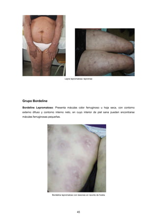 Lepra lepromatosa: lepromas
Grupo Bordeline
Bordeline Lepromatoso: Presenta máculas color ferruginoso u hoja seca, con contorno
externo difuso y contorno interno neto, en cuyo interior de piel sana pueden encontrarse
máculas ferruginosas pequeñas.
Bordeline lepromatoso con lesiones en recorte de hostia
45
 