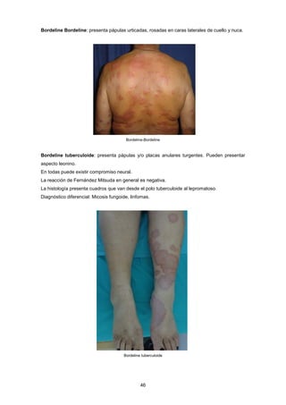 Bordeline Bordeline: presenta pápulas urticadas, rosadas en caras laterales de cuello y nuca.
Bordeline-Bordeline
Bordeline tuberculoide: presenta pápulas y/o placas anulares turgentes. Pueden presentar
aspecto leonino.
En todas puede existir compromiso neural.
La reacción de Fernández Mitsuda en general es negativa.
La histología presenta cuadros que van desde el polo tuberculoide al lepromatoso.
Diagnóstico diferencial: Micosis fungoide, linfomas.
Bordeline tuberculoide
46
 
