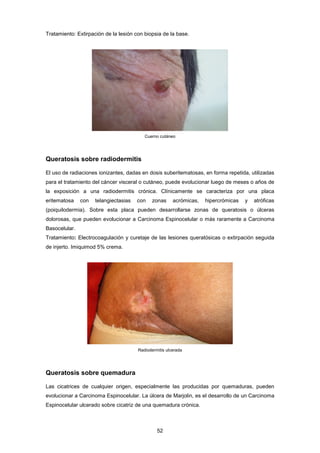 Tratamiento: Extirpación de la lesión con biopsia de la base.
Cuerno cutáneo
Queratosis sobre radiodermitis
El uso de radiaciones ionizantes, dadas en dosis suberitematosas, en forma repetida, utilizadas
para el tratamiento del cáncer visceral o cutáneo, puede evolucionar luego de meses o años de
la exposición a una radiodermitis crónica. Clínicamente se caracteriza por una placa
eritematosa con telangiectasias con zonas acrómicas, hipercrómicas y atróficas
(poiquilodermia). Sobre esta placa pueden desarrollarse zonas de queratosis o úlceras
dolorosas, que pueden evolucionar a Carcinoma Espinocelular o más raramente a Carcinoma
Basocelular.
Tratamiento: Electrocoagulación y curetaje de las lesiones queratósicas o extirpación seguida
de injerto. Imiquimod 5% crema.
Radiodermitis ulcerada
Queratosis sobre quemadura
Las cicatrices de cualquier origen, especialmente las producidas por quemaduras, pueden
evolucionar a Carcinoma Espinocelular. La úlcera de Marjolin, es el desarrollo de un Carcinoma
Espinocelular ulcerado sobre cicatriz de una quemadura crónica.
52
 