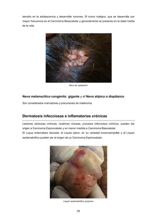 tamaño en la adolescencia y desarrollar tumores. El tumor maligno, que se desarrolla con
mayor frecuencia es el Carcinoma Basocelular y generalmente se presenta en la edad media
de la vida.
Nevo de Jadassohn
Nevo melanocítico congénito gigante y el Nevo atípico o displásico
Son considerados marcadores y precursores de melanoma.
Dermatosis infecciosas e inflamatorias crónicas
Lesiones ulcerosas crónicas, cicatrices viciosas, procesos infecciosos crónicos, pueden dar
origen a Carcinoma Espinocelular y en menor medida a Carcinoma Basocelular.
El Lupus eritematoso discoide, el Liquen plano, en su variedad erosivoampollar y el Líquen
escleroatrófico pueden ser el origen de un Carcinoma Espinocelular.
Liquen escleroatrófico purpúrico
55
 