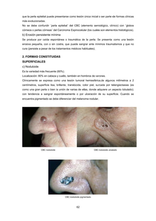 que la
más e
No s
córne
b) Er
Se p
erosiv
cura
2. FO
SUP
c) No
Es la
Local
Clínic
centím
como
con t
encue
a perla epite
evolucionada
se debe con
eos o perlas
rosión persi
produce por
va pequeña
(persiste a p
ORMAS CO
ERFICIALE
oduloide
variedad má
lización: 80%
camente se
metros, sup
o una gran p
tendencia a
entra pigmen
C
elial puede p
as.
nfundir ¨perla
córneas¨ de
istente míni
caída espo
, con o sin c
pesar de los t
ONSTITUID
ES
ás frecuente
% en cabeza
expresa co
erficie lisa,
perla o bien l
sangrar es
ntado se deb
CBC noduloide
resentarse c
a epitelial¨ d
l Carcinoma
ma
ntánea o tra
costra, que
tratamientos
AS
(60%).
y cuello, tam
omo una les
brillante, tra
la unión de v
spontáneame
be diferencia
CBC n
62 
como lesión
del CBC (ele
Espinocelula
aumática de
puede sang
s médicos ha
mbién en hom
sión tumoral
anslúcida, co
varias de ell
ente o por
ar del melano
noduloide pigm
única inicial
emento sem
ar (los cuale
e la perla. S
rar ante mín
abituales).
mbros de var
hemiesféric
olor piel, su
as, donde a
ulceración d
oma nodular.
CBC
entado
o ser parte d
miológico, clín
s son eleme
Se presenta
nimos traum
rones.
ca,de alguno
rcada por te
dquiere un a
de su super
noduloide ulcer
de formas cl
nico) con ¨g
entos histológ
como una
matismos y q
os milímetro
elangiectasia
aspecto lobu
rficie. Cuand
rado
ínicas
globos
gicos).
lesión
ue no
s a 2
as (es
ulado);
do se
 