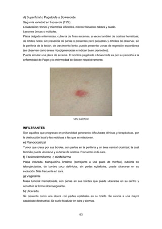 d) Su
Segu
Local
Lesio
Placa
de lím
la pe
(se o
Pued
enfer
INFIL
Son a
la des
e) Pl
Tumo
tamb
f) Es
Placa
telang
evolu
g) Ve
Masa
const
h) Ul
Se p
capac
uperficial o
unda variedad
lización: tron
ones únicas o
a delgada er
mites netos;
riferia de la
bservan com
de simular un
rmedad de P
LTRANTES
aquéllos que
strucción loc
anocicatriza
or que crece
ién puede ul
clerodermif
a indurada,
giectasias, d
ución. Más fre
egetante
a tumoral ma
tituir la forma
lcerada
presenta com
cidad destru
Pagetoide o
d en frecuen
nco y miembr
o múltiples.
ritematosa, c
sin presenci
lesión; de cr
mo áreas hipo
na placa de e
Paget y/o enfe
S
e progresan
cal y las recid
al
e por sus bor
cerarse y cu
forme o mo
blanquecina
de bordes
ecuente en c
amelonada,
a úlcerovege
mo una úlce
ctiva. Se sue
o Bowenoid
ncia (15%).
ros inferiores
cubierta de fi
a de perlas
recimiento le
opigmentada
eccema. El n
ermedad de
en profundid
divas a las qu
rdes, con pe
ubrirse de cos
orfeiforme
a, brillante
poco definid
cara.
con perlas
etante.
era con perla
ele localizar e
63 
de
s, menos frec
nas escama
o presentes
ento; puede
as e indican
nombre page
Bowen resp
CBC superficia
dad generan
ue se relacio
erlas en la pe
stras. Frecue
(semejante
dos, sin pe
en sus bord
as epiteliale
en cara y pie
cuente cabe
as, a veces ta
pero peque
presentar zo
buen pronós
etoide o bowe
pectivamente
al
do dificultad
onan.
eriferia y un
ente en la ca
a una pla
erlas epitelia
des que pue
es en su bo
ernas.
za y cuello.
ambién de c
ñas y difícile
onas de regr
stico).
enoide es po
.
es clínicas y
área central
ara.
ca de morf
ales, puede
ede ulcerars
rde. Se aso
costras hemá
es de observ
resión espon
or su parecid
y terapéutica
l cicatrizal, la
rfea), cubier
ulcerarse e
se en su ce
ocia a una m
áticas;
var, en
ntánea
do a la
as, por
a cual
rta de
en su
ntro y
mayor
 