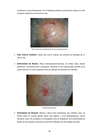 L
e
 T
C
 E
p
p
 E
lí
fr
B
Localizada en
el espesor ep
Tipo Cuern
CEC in situ.
Enfermedad
policíclicos, c
puede observ
Eritroplasia
ímites netos
recuente vul
Bowen en las
n área fotoe
pidérmico (ca
CEC a
no Cutáneo
d de Bow
crecimiento l
var en zonas
a de Quey
s en mucos
va). Se cons
s mucosas; e
xpuesta. En
arcinoma in s
partir de la tran
o: Lesión tip
wen: Placa
lento y prog
s cubiertas (c
Enf
rat: Mácula
a genital (s
sidera a la e
evoluciona a
68 
la histología
situ).
nsformación de
po cuerno c
eritematoes
resivo, frecu
como por eje
fermedad de Bo
a o placa ún
sobre todo
eritroplasia c
carcinoma in
a presenta q
una queratosis
cutáneo que
camocostros
uente en pie
emplo en pac
owen
nica eritema
glande y su
como la loca
nfiltrante con
queratinocitos
actínica
presenta la
sa, de límite
el fotoexpues
cientes con H
atosa, lisa, b
urco balano
alización de l
n más rapide
s atípicos en
a histología
es netos, b
sta, también
HACRE).
brillante, sec
oprepucial, m
la Enfermed
ez que ésta.
n todo
de un
bordes
se la
ca, de
menos
ad de
 