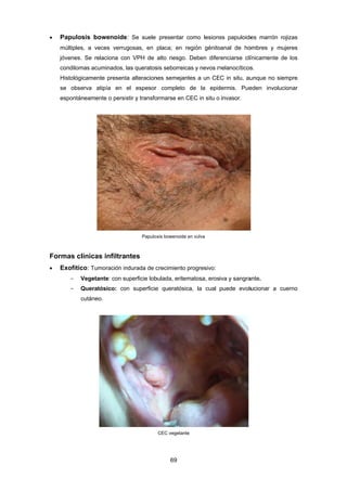  P
m
jó
c
H
s
e
Form
 E
Papulosis b
múltiples, a
óvenes. Se
condilomas a
Histológicame
se observa
espontáneam
mas clínic
Exofítico: T
- Vege
- Quer
cután
bowenoide
veces verru
relaciona co
acuminados,
ente present
atipía en
mente o persi
cas infiltra
Tumoración in
etante: con s
ratósico: co
neo.
e: Se suele
ugosas, en
on VPH de
las queratos
ta alteracion
el espesor
istir y transfo
Papulos
antes
ndurada de c
superficie lob
on superficie
69 
presentar c
placa; en re
alto riesgo.
sis seborreica
nes semejant
r completo
ormarse en C
sis bowenoide e
crecimiento p
bulada, eritem
e queratósic
CEC vegetante
como lesione
egión génito
Deben difer
as y nevos m
tes a un CE
de la epid
CEC in situ o
en vulva
progresivo:
matosa, eros
ca, la cual
e
es papuloide
oanal de ho
renciarse clí
melanocíticos
EC in situ, au
dermis. Pue
invasor.
iva y sangra
puede evolu
es marrón r
ombres y m
ínicamente d
s.
unque no sie
eden involuc
ante.
ucionar a c
rojizas
ujeres
de los
empre
cionar
cuerno
 