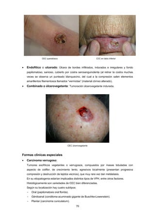  E
p
v
a
 C
Form
 C
T
a
c
E
H
S
-
-
-
Endofítico
papilomatoso
veces se obs
amarillentos f
Combinado
mas clínic
Carcinoma
Tumores exo
aspecto de
compresión y
En su etiopat
Histológicame
Según su loc
- Oral (pap
- Génitoan
- Plantar (c
CEC queratósic
o ulcerado
o, sanioso, c
serva un pu
filamentosos
o o úlcerov
cas especi
verrugoso
ofíticos veg
coliflor, de
y destrucción
togenia estar
ente son var
alización hay
pilomatosis o
al (condilom
carcinoma cu
co
o: Úlcera de
cubierto por
unteado blan
s llamados “v
vegetante: T
CE
iales
o:
etantes o v
crecimiento
n de tejidos v
rían implicad
riedades de C
y cuatro subt
ral florida).
a acuminado
uniculatum).
70 
e bordes inf
costra seros
nquecino, de
vermiotas” (m
Tumoración
EC úlcerovegeta
verrugosos,
lento, agre
vecinos), que
dos distintos
CEC bien dif
tipos:
o gigante de
CE
filtrados, ind
sanguinolent
el cual a la
material córne
úlcerovegeta
ante
compuestos
esivos localm
e muy rara ve
tipos de VPH
ferenciadas.
Buschke-Lo
EC en labio infe
urados e irr
ta (al retirar
compresión
eo alterado).
ante indurada
s por masa
mente (pres
ez dan metás
H, entre otros
owenstein).
erior
regulares y
la costra m
n salen elem
.
a.
as lobuladas
sentan prog
stasis.
s factores.
fondo
uchas
mentos
s con
resiva
 