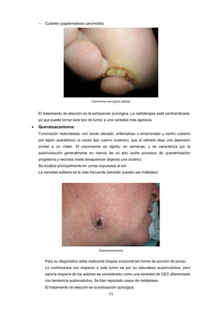 -
E
y
 Q
T
p
s
a
p
S
L
- Cutáneo
El tratamiento
ya que puede
Queratoaca
Tumoración r
por tapón qu
similar a un
autoinvolució
progresiva y n
Se localiza pr
La variedad s
Para su d
La contro
para la m
con tende
El tratam
(papilomatos
o de elección
e tornar este
antoma:
redondeada,
ueratósico (a
cráter. El
n generalme
necrosis has
rincipalmente
solitaria es la
diagnóstico d
oversia con
mayoría de lo
encia autoinv
iento de elec
sis carcinoid
Carcin
n es la extirp
tipo de tumo
con borde
a veces tipo
crecimiento
ente en me
sta desapare
e en zonas e
a más frecue
Q
debe realizar
respecto a
s autores es
volutiva. Se h
cción es la ex
71 
e).
noma verrugoso
pación quirú
or a una vari
elevado, erit
cuerno cutá
o es rápido,
enos de un
ecer dejando
expuestas al
nte (también
Queratoacantom
rse biopsia in
este tumor
s considerado
han reportad
xtirpación qu
plantar
rgica. La rad
edad más ag
tematoso o
áneo), que a
, en seman
año (sufre
una cicatriz)
sol.
n pueden ser
ma
ncisional (en
es por su n
o como una
do casos de
uirúrgica.
dioterapia es
gresiva.
amarronado
al retirarlo de
nas, y se c
procesos d
).
r múltiples).
forma de po
aturaleza au
variedad de
metástasis.
stá contraind
o y centro cu
eja una dep
caracteriza p
de queratiniz
orción de pizz
utoinvolutiva
CEC diferen
icada,
ubierto
resión
por la
zación
za).
, pero
nciado
 