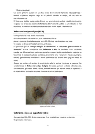  M
Los c
dérm
crecim
El Me
sin p
pronó
Mela
Corre
De bu
Afect
Se lo
Es p
Dubr
macu
la de
tama
años)
Cuan
carac
adqu
en es
Mela
Corre
De pr
Melanoma no
cuatro prime
ico superfic
miento vertic
elanoma No
asar por la f
óstico, se rel
anoma len
esponde al 5
uen pronósti
ta a personas
ocaliza en áre
precedido po
reuilh”: el c
ular con difer
rmis), de bo
ño, generalm
).
ndo se prod
cterísticas de
iere tonos g
stadíos más
anoma ext
esponde al 5
ronóstico inte
odular
eros cursan
cial, seguida
cal.
dular cursa
fase de crec
aciona a una
ntigo malig
5 - 10% de lo
co con respe
s de edad av
eas con fotod
or el “lentig
cual corresp
rentes tonos
rdes irregula
mente asinto
duce el cam
e Melanoma
grisáceos, az
avanzados s
tensivo su
50 - 70% de l
ermedio.
con una fas
a luego de
desde el ini
cimiento hori
a mayor capa
gno (MLM
s melanoma
ecto a otras v
vanzada, ent
daño crónico
go maligno
onde a un
pardo-negru
ares, asimétr
omática. Pue
mbio de crec
a Lentigo M
zules, rojizos
se puede obs
Melan
uperficial
os melanom
75 
se inicial de
un período
icio con un c
izontal. El cr
acidad para
M)
as.
variedades c
tre 60 - 70 añ
o, en la cara.
de Hutchi
melanoma
uzcos (sin gr
rica, crecimie
ede permane
cimiento rad
Maligno (inv
s, también b
servar erosio
noma lentigo m
(MES)
mas. Es la var
e crecimiento
o variable d
crecimiento
recimiento ve
invadir tejido
clínicas.
ños, a ambo
nson” o “m
in situ. Se
rises ni azule
ento lento y
ecer así dur
dial a vertica
vasor): apare
lancos que
ones y sangr
maligno
riedad más f
o horizontal
de tiempo,
vertical intra
ertical es un
os y metasta
s sexos por
melanosis p
manifiesta
es que indica
progresivo h
rante años (
al comienza
ecen sectore
indican zona
rado.
frecuente en
intraepidérm
de una fas
adérmico inv
n indicador d
atizar.
igual.
precanceros
como una
arían melani
hasta adquiri
(algunos has
a a presenta
es sobreelev
as de regres
blancos.
mico o
se de
vasivo,
de mal
sa de
lesión
ina en
r gran
sta 20
ar las
vados,
sión, y
 