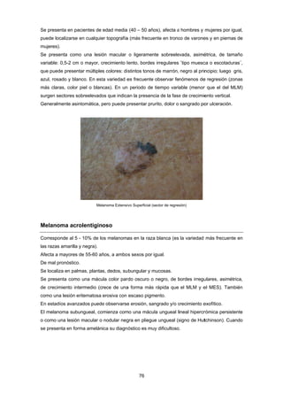 Se pr
pued
mujer
Se p
variab
que p
azul,
más
surge
Gene
Mela
Corre
las ra
Afect
De m
Se lo
Se pr
de cr
como
En es
El me
o com
se pr
resenta en p
e localizarse
res).
presenta com
ble: 0,5-2 cm
puede presen
rosado y bla
claras, color
en sectores s
eralmente as
anoma ac
esponde al 5
azas amarilla
ta a mayores
mal pronóstico
ocaliza en pa
resenta com
recimiento in
o una lesión e
stadíos avan
elanoma sub
mo una lesió
resenta en fo
pacientes de
e en cualquie
mo una lesió
m o mayor, c
ntar múltiple
anco. En est
r piel o blan
sobreelevado
sintomática, p
Mel
rolentigin
5 - 10% de lo
a y negra).
s de 55-60 añ
o.
lmas, planta
mo una mácu
ntermedio (c
eritematosa
nzados puede
bungueal, co
ón macular o
orma amelán
edad media
er topografía
ón macular
crecimiento l
s colores: dis
ta variedad e
cas). En un
os que indica
pero puede p
anoma Extensiv
oso
os melanoma
ños, a ambos
s, dedos, su
ula color pard
rece de una
erosiva con
e observarse
omienza com
nodular neg
ica su diagnó
76 
(40 – 50 añ
a (más frecue
o ligeramen
ento, bordes
stintos tonos
es frecuente
periodo de
an la presenc
presentar pru
vo Superficial (s
as en la raza
s sexos por
bungular y m
rdo oscuro o
a forma más
escaso pigm
e erosión, sa
mo una mácu
gra en pliegu
óstico es mu
os), afecta a
ente en tronc
nte sobreele
s irregulares
s de marrón,
observar fe
tiempo vari
cia de la fase
urito, dolor o
sector de regres
a blanca (es
igual.
mucosas.
o negro, de b
s rápida que
mento.
angrado y/o c
ula ungueal l
ue ungueal (s
uy dificultoso
a hombres y
co de varone
evada, asimé
¨tipo muesc
negro al prin
nómenos de
able (menor
e de crecimie
sangrado po
sión)
la variedad
bordes irregu
el MLM y e
crecimiento e
ineal hipercr
signo de Hut
.
mujeres por
es y en piern
étrica, de ta
ca o escotad
ncipio; luego
e regresión (
r que el del
ento vertical
or ulceración
más frecuen
ulares, asim
el MES). Ta
exofítico.
rómica persis
tchinson). Cu
igual,
nas de
amaño
duras¨,
o gris,
zonas
MLM)
.
n.
nte en
étrica,
mbién
stente
uando
 