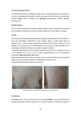 Factores predisponentes
Los factores que causan que Malassezia furfur actúe en algunas personas como patógenos y
en otras se mantenga como saprófito no están muy claros. A este fenómeno contribuyen tanto
factores locales (calor, humedad) como generales (predisposición genética, diabetes,
embarazo, etc.).
Epidemiología
Es una micosis de distribución mundial que afecta a todas las razas, más frecuente en hombres
que en mujeres. Su incidencia es mayor en adultos jóvenes y en climas cálidos y húmedos.
Clínica
Se caracteriza clínicamente por la presencia de máculas de pequeño tamaño (2-4mm hasta 1 o
2cm), bien delimitadas, confluentes, de color variable, desde un rosado tenue hasta un
parduzco claro o café con leche, terminando por adquirir el color blanco, sobre todo si las
lesiones se han expuesto al sol, destacándose de la piel que la rodea (variedad hipo o
acromiante), justificando el nombre de versicolor (variedad de colores).
La superficie está cubierta por finas escamas, de aspecto farináceo, que se visualizan muy bien
si las raspamos con la uña o con la cureta, desprendiéndose una fina descamación
pulverulenta: signo del uñazo o de la viruta.
Afecta predominantemente el tórax, en especial, la parte superior del pecho, hombros, espalda,
cuello y con menor frecuencia abdomen, extremidades superiores y cara.
Es asintomática y tiene gran tendencia a la recidiva.
Pitiriasis versicolor: máculas hiper e hipocrómicas en tronco y miembros
Diagnóstico
Se establece por la clínica; por la iluminación con la luz de Wood, con la cual las lesiones se
tornarán fluorescentes (amarillo dorado) y con el examen directo con hidróxido de potasio al
90
 