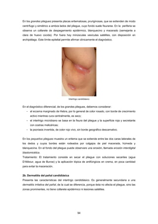 En los grandes pliegues presenta placas eritematosas, pruriginosas, que se extienden de modo
centrífugo y simétrico a ambos lados del pliegue, cuyo fondo suele fisurarse. En la periferia se
observa un collarete de despegamiento epidérmico, blanquecino y macerado (semejante a
clara de huevo cocida). Por fuera hay minúsculas vesículas satélites, con disposición en
archipiélago. Este límite epitelial permite afirmar clínicamente el diagnóstico.
Intertrigo candidiásico
En el diagnóstico diferencial, de los grandes pliegues, debemos considerar:
­ el eccema marginado de Hebra, por lo general de color rosado, con borde de crecimiento
activo mientras cura centralmente, es seco;
­ el intertrigo microbiano se basa en la fisura del pliegue y la superficie roja y secretante
con costras melicéricas;
­ la psoriasis invertida, de color rojo vivo, sin borde geográfico descamativo.
En los pequeños pliegues muestra un eritema que se extiende entre las dos caras laterales de
los dedos y cuyos bordes están rodeados por colgajos de piel macerada, húmeda y
blanquecina. En el fondo del pliegue puede observare una erosión, llamada erosión interdigital
blastomicética.
Tratamiento: El tratamiento consiste en secar el pliegue con soluciones secantes (agua
D’Alibour, agua de Burow) y la aplicación tópica de antifúngicos en crema, en poca cantidad
para evitar la maceración.
2b. Dermatitis del pañal candidiásica
Presenta las características del intertrigo candidiásico. Es generalmente secundaria a una
dermatitis irritativa del pañal, de la cual se diferencia, porque ésta no afecta el pliegue, sino las
zonas prominentes, no tiene collarete epidérmico ni lesiones satélites.
94
 