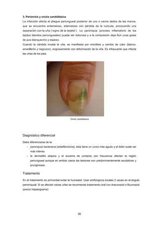 3. Perionixis y onixis candidiásica
La infección afecta el pliegue periungueal posterior de uno o varios dedos de las manos,
que se encuentra eritematoso, edematoso con pérdida de la cutícula, provocando una
separación con la uña (“signo de la tarjeta”). La paroniquia (proceso inflamatorio de los
tejidos blandos periungueales) puede ser dolorosa y a la compresión deja fluir unas gotas
de pus blanquecino y espeso.
Cuando la cándida invade la uña, se manifiesta por onicólisis y cambio de color (blanco,
amarillento y negruzco), engrosamiento con deformación de la uña. Es infrecuente que infecte
las uñas de los pies.
Onixis candidiásica
Diagnóstico diferencial
Debe diferenciarse de la:
­ paroniquia bacteriana (estafilocócica), ésta tiene un curso más agudo y el dolor suele ser
más intenso.
­ la dermatitis atópica y el eccema de contacto con frecuencia afectan la región
periungueal aunque en ambos casos las lesiones son predominantemente exudativas y
pruriginosas.
Tratamiento
En el tratamiento es primordial evitar la humedad. Usar antifúngicos locales 2 veces en el ángulo
perioniquial. Si se afectan varias uñas se recomienda tratamiento oral con itraconazol o fluconazol
(previo hepatograma).
95
 