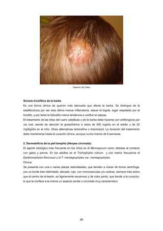 Querion de Celso
Sicosis tricofítica de la barba
Es una forma clínica de querion más atenuada que afecta la barba. Se distingue de la
estafilocócica por ser esta última menos inflamatoria, atacar el bigote, lugar respetado por el
tricofito, y por tener la foliculitis menor tendencia a confluir en placas.
El tratamiento de las tiñas del cuero cabelludo y de la barba debe hacerse con antifúngicos por
vía oral, siendo de elección la griseofulvina a dosis de 500 mg/día en el adulto y de 20
mg/Kg/día en el niño. Otras alternativas terbinafina o itraconazol. La duración del tratamiento
debe mantenerse hasta la curación clínica, aunque nunca menos de 8 semanas.
2. Dermatoficia de la piel lampiña (Herpes circinado)
El agente etiológico más frecuente en los niños es el Microsporum canis, debidas al contacto
con gatos y perros. En los adultos es el Trichophyton rubrum y con menor frecuencia el
Epidermophyton floccosun y el T. mentagrophytes var. mentagrophytes.
Clínica
Se presenta con una o varias placas redondeadas, que tienden a crecer de forma centrífuga,
con un borde bien delimitado, elevado, rojo, con microvesículas y/o costras; siempre más activo
que el centro de la lesión, es ligeramente escamoso y de color pardo, que tiende a la curación,
lo que le confiere a la misma un aspecto anular o circinado muy característico.
99
 