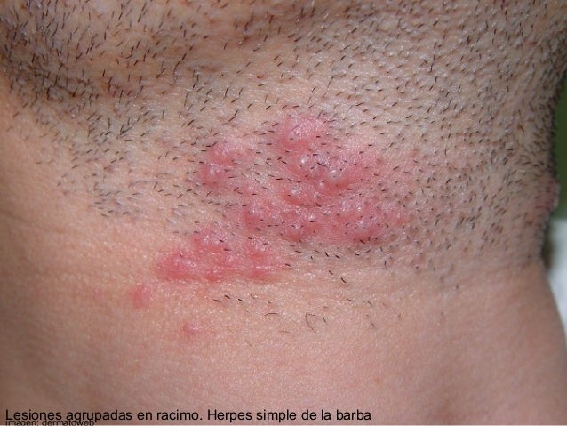 urticaria cuero cabelludo dermatologia diagn 243 stico cl 237 nico ana 2010 publicar blog urticaria cuero cabelludo dermatologia diagn 243 stico cl 237 nico ana 2010 publicar blog
